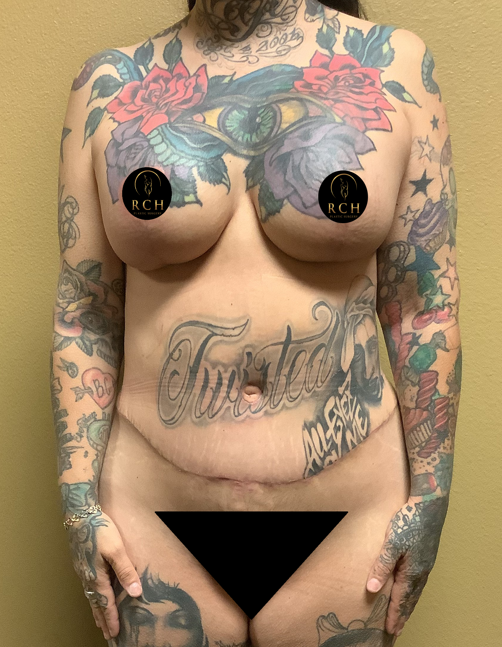 Mommy Makeover images in Tyler TX