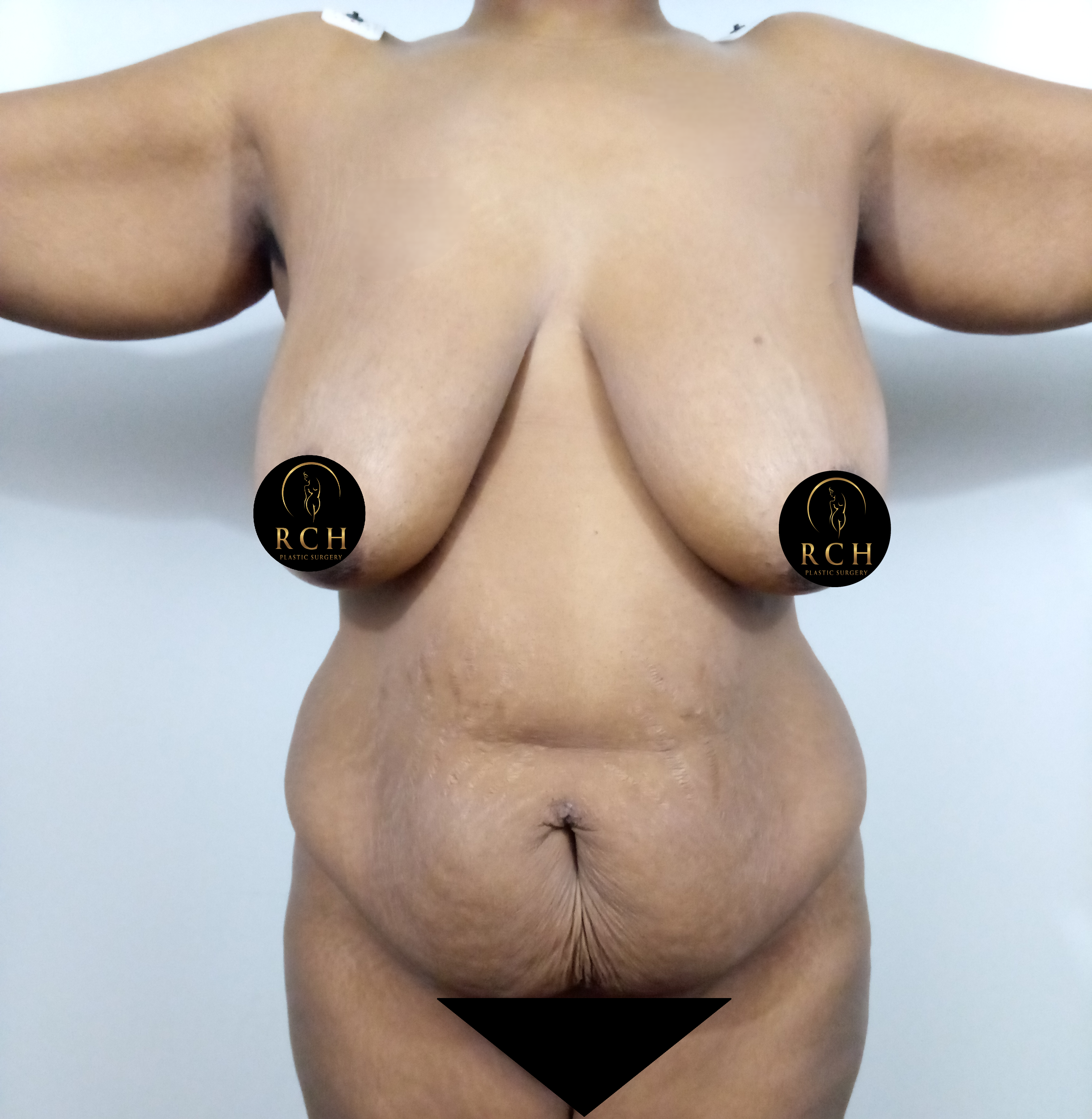 Mommy Makeover in Tyler Texas