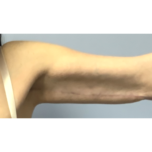 After arm lift left arm