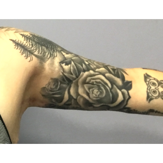 After arm lift left arm