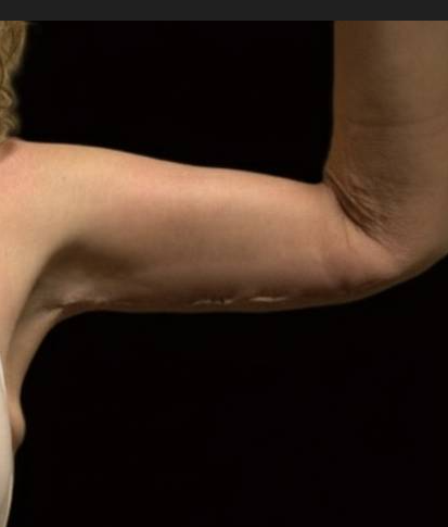 After arm lift left arm