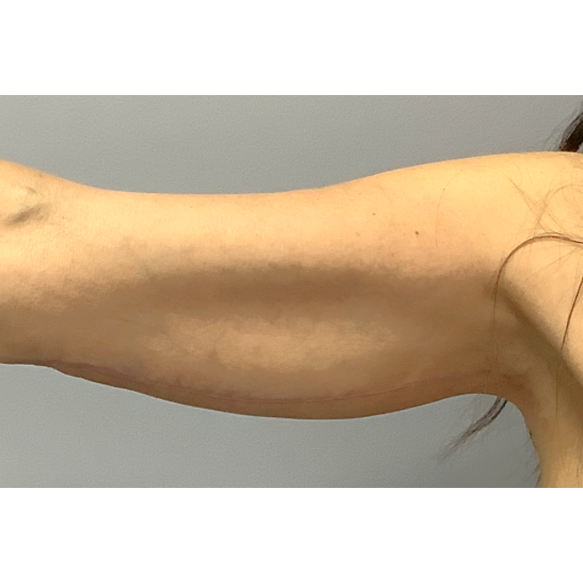 After arm lift right arm