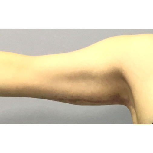 After arm lift right arm