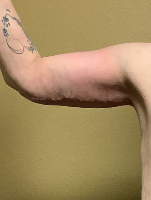 After arm lift right arm