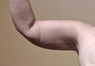After arm lift right arm