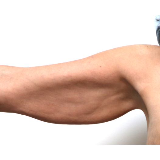 Before arm lift right arm