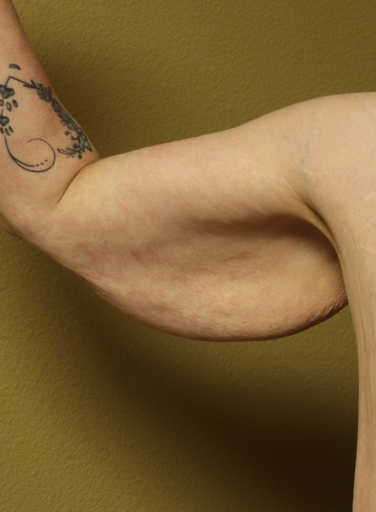 Before arm lift right arm