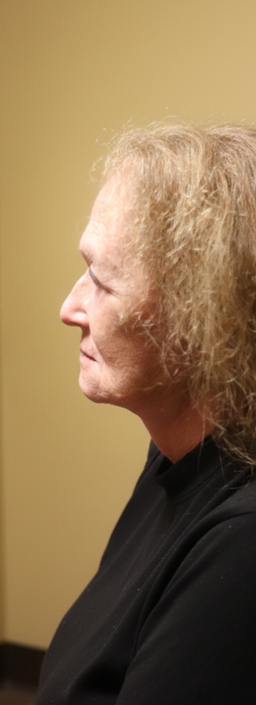 After face lift side view