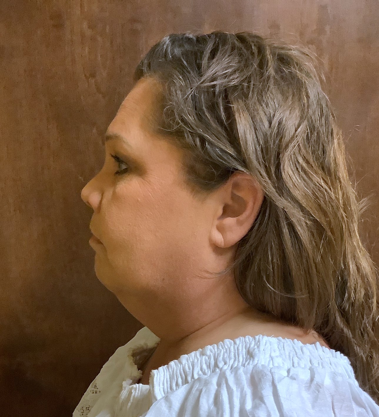 Before facelift side